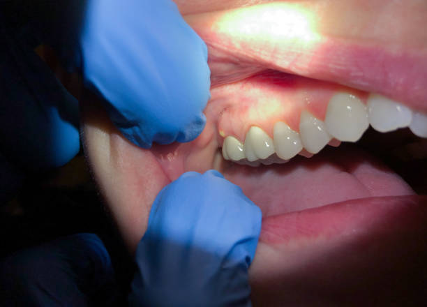 Best Emergency Dental Care for Broken or Chipped Teeth in Bethany, MO